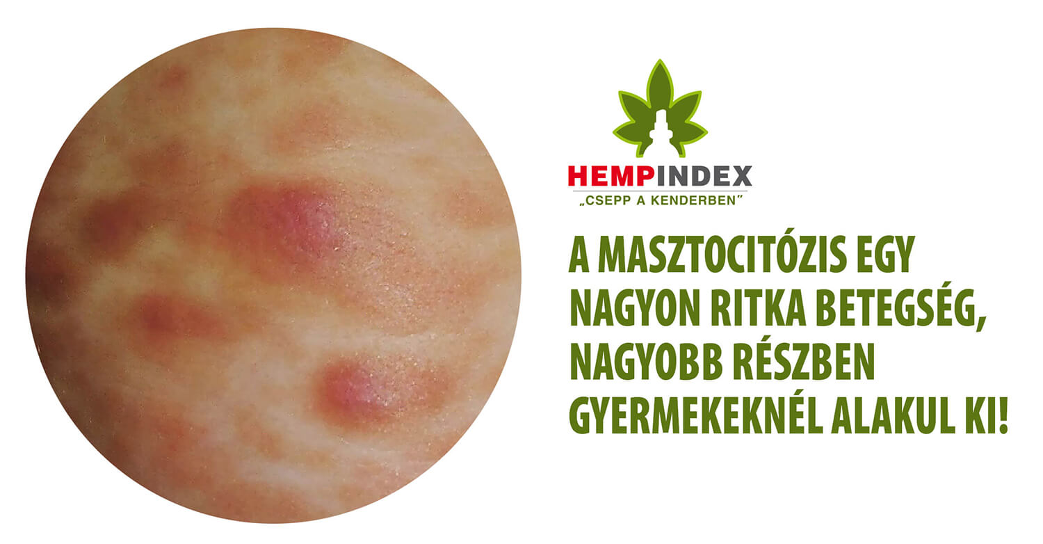 Bőr masztocitózis és a CBD: egy édesanya tapasztalatai 