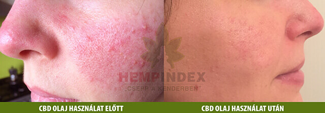 Kellemetlen bőrpír: így enyhült a rosacea CBD és CBG olajjal! 
